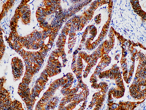 Immunohistochemistry of paraffinembedded Human colon tissue with Beta-catenin Monoclonal Antibody(Antigen repaired by EDTA).