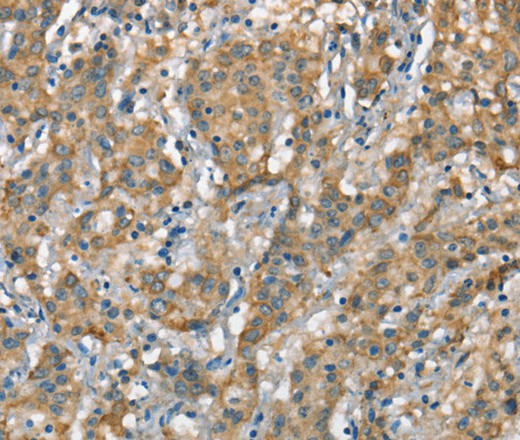 Immunohistochemistry of paraffin-embedded Human gasrtic cancer tissue using CSMD1 Polyclonal Antibody at dilution 1:40