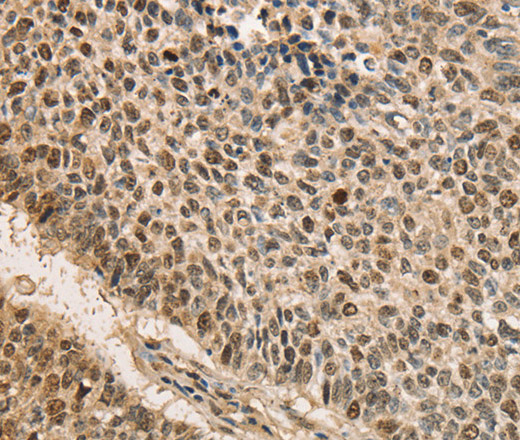 Immunohistochemistry of paraffin-embedded Human lung cancer using CDCA8 Polyclonal Antibody at dilution of 1:40