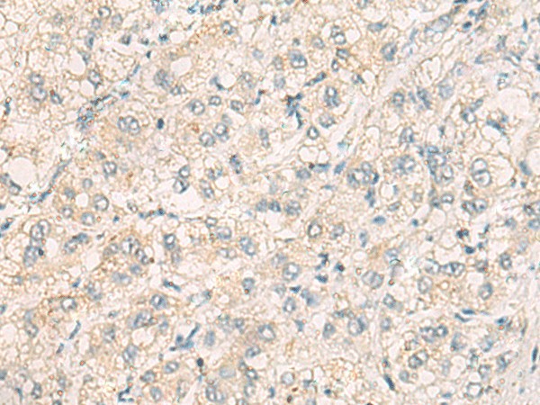 Immunohistochemistry of paraffin-embedded Human liver cancer tissue  using THG1L Polyclonal Antibody at dilution of 1:70(?200)