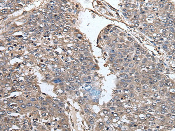 Immunohistochemistry of paraffin-embedded Human liver cancer tissue  using PRUNE Polyclonal Antibody at dilution of 1:40(?200)