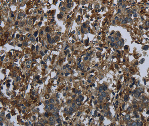 Immunohistochemistry of paraffin-embedded Human liver cancer using GLUL Polyclonal Antibody at dilution of 1:60