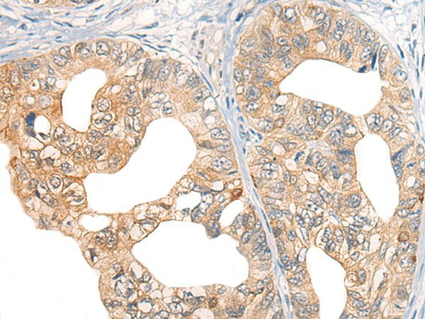 Immunohistochemistry of paraffin-embedded Human gastric cancer tissue  using CORO2A Polyclonal Antibody at dilution of 1:45(?200)