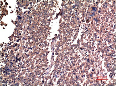 Immunohistochemistry of paraffin-embedded Human lung carcinoma tissue using Cyclin B1 Monoclonal Antibody at dilution of 1:200.