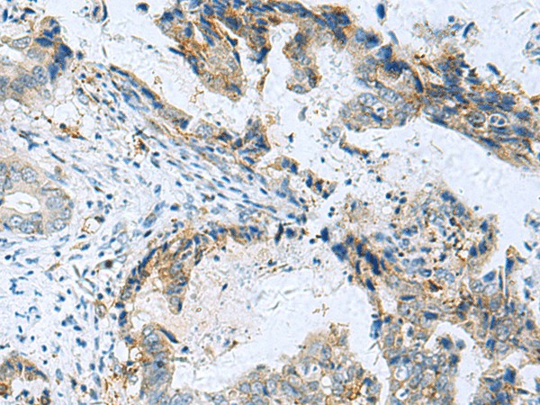 Immunohistochemistry of paraffin-embedded Human cervical cancer tissue  using RMDN2 Polyclonal Antibody at dilution of 1:70(?200)