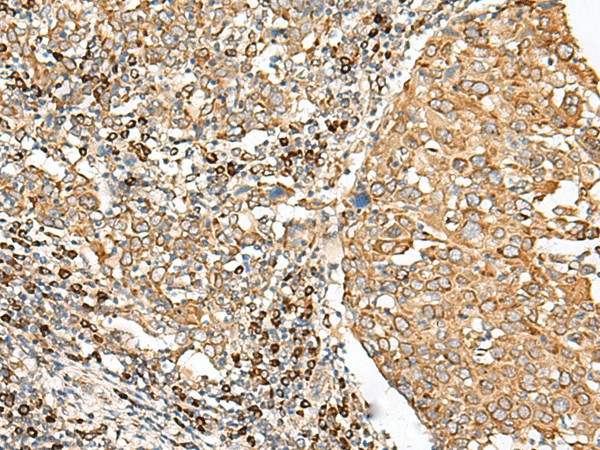 Immunohistochemistry of paraffin-embedded Human cervical cancer tissue  using STT3A Polyclonal Antibody at dilution of 1:70(?200)