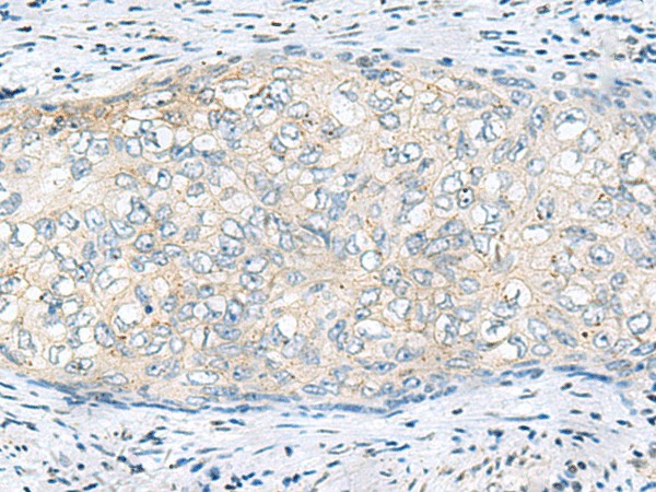 Immunohistochemistry of paraffin-embedded Human cervical cancer tissue  using VEGFA Polyclonal Antibody at dilution of 1:60(?200)