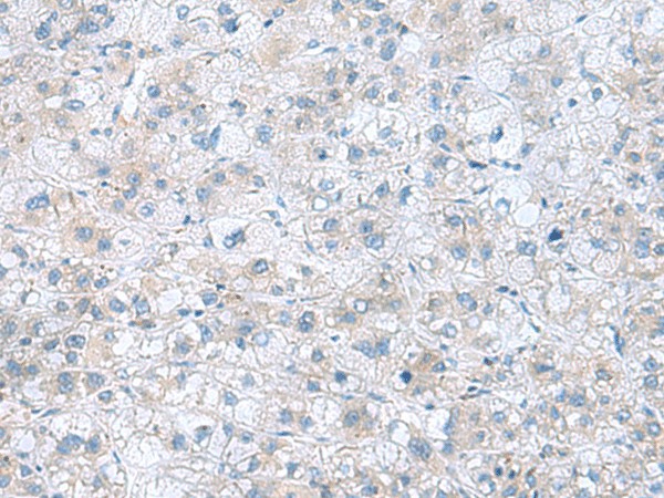 Immunohistochemistry of paraffin-embedded Human liver cancer tissue  using TXNDC12 Polyclonal Antibody at dilution of 1:60(?200)