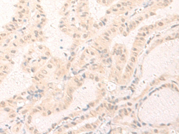 Immunohistochemistry of paraffin-embedded Human thyroid cancer tissue  using IL7 Polyclonal Antibody at dilution of 1:30(?200)