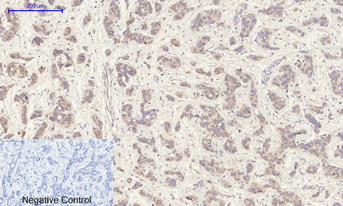 Immunohistochemistry of paraffin-embedded Human liver cancer tissue using EGFR Polyclonal Antibody at dilution of 1:200.