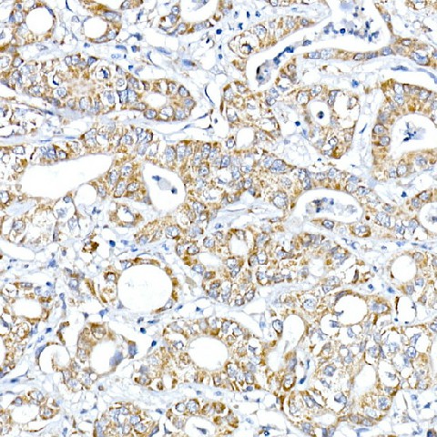 Immunohistochemistry of paraffin-embedded human liver cancer using PTPIP51/RMDN3 Polyclonal Antibody at dilution of 1:100 (40x lens).Perform high pressure antigen retrieval with 10 mM citrate buffer pH 6.0 before commencing with IHC staining protocol.