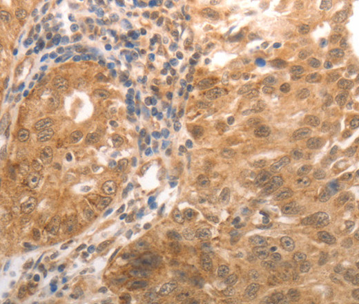 Immunohistochemistry of paraffin-embedded Human ovarian cancer tissue using MMP27 Polyclonal Antibody at dilution 1:50