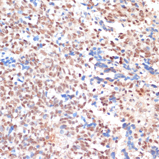 Immunohistochemistry of paraffin-embedded human oophoroma using NAA20 Polyclonal antibody at dilution of 1:100 (40x lens).Perform microwave antigen retrieval with 10 mM PBS buffer pH 7.2 before commencing with IHC staining protocol.