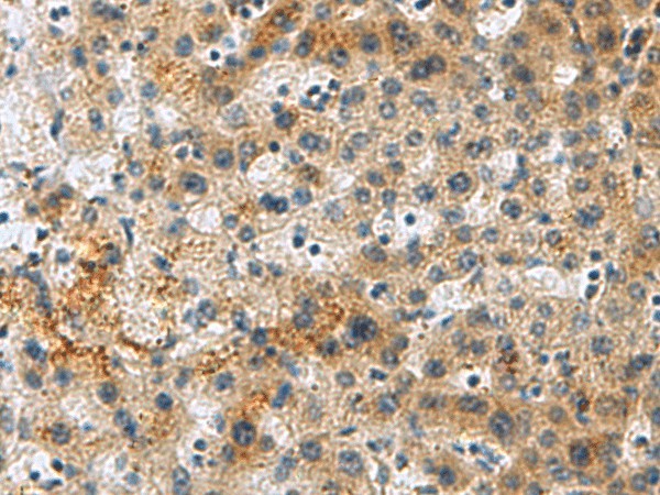 Immunohistochemistry of paraffin-embedded Human liver cancer tissue  using PLIN4 Polyclonal Antibody at dilution of 1:50(?200)