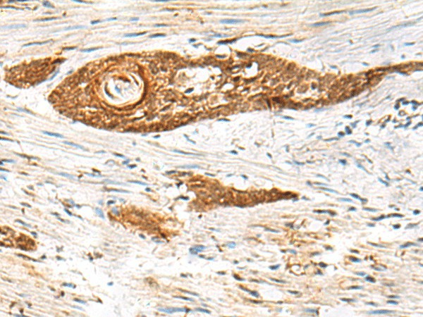 Immunohistochemistry of paraffin-embedded Human esophagus cancer tissue  using GPSM1 Polyclonal Antibody at dilution of 1:85(?200)