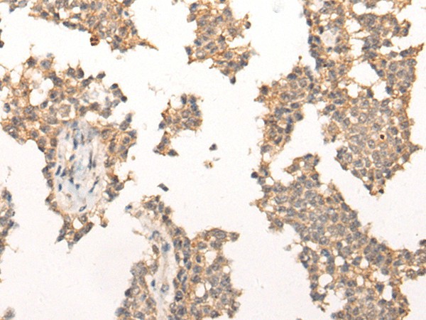 Immunohistochemistry of paraffin-embedded Human ovarian cancer tissue  using PIAS3 Polyclonal Antibody at dilution of 1:40(?200)