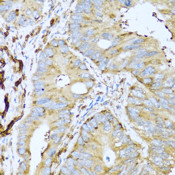 Immunohistochemistry of paraffin-embedded Human colon carcinoma using CSH1 Polyclonal Antibody at dilution of 1:100 (40x lens).