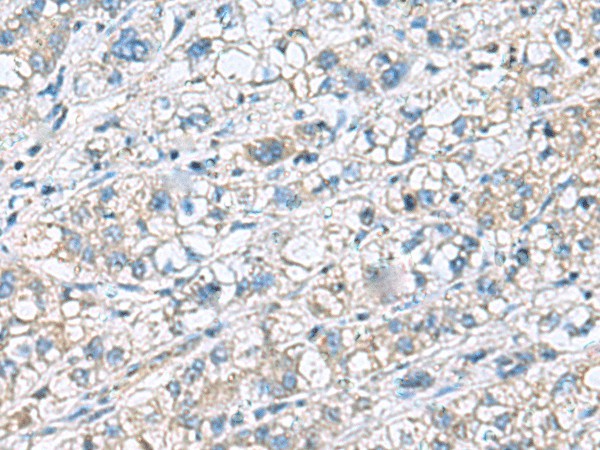 Immunohistochemistry of paraffin-embedded Human liver cancer tissue  using KRCC1 Polyclonal Antibody at dilution of 1:60(?200)