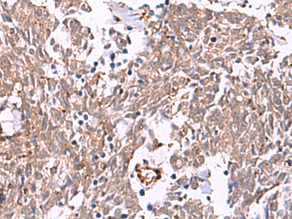 Immunohistochemistry of paraffin-embedded Human lung cancer tissue  using IRX2 Polyclonal Antibody at dilution of 1:45(?200)