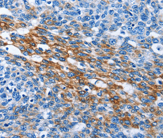 Immunohistochemistry of paraffin-embedded Human ovarian cancer tissue using PAK6 Polyclonal Antibody at dilution 1:40