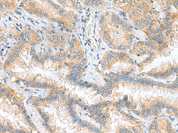 Immunohistochemistry of paraffin-embedded Human lung cancer tissue  using RPS16 Polyclonal Antibody at dilution of 1:60(?200)