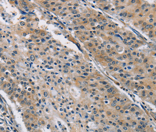 Immunohistochemistry of paraffin-embedded Human gastric cancer using BMP15 Polyclonal Antibody at dilution of 1:40