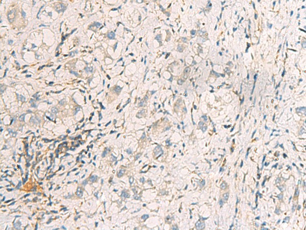 Immunohistochemistry of paraffin-embedded Human liver cancer tissue  using SUSD3 Polyclonal Antibody at dilution of 1:95(?200)