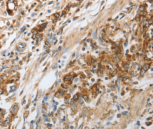 Immunohistochemistry of paraffin-embedded Human gastic cancer using NPY1R Polyclonal Antibody at dilution of 1:30