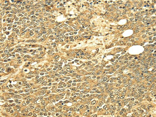 Immunohistochemistry of paraffin-embedded Human ovarian cancer using ECE2 Polyclonal Antibody at dilution of  1/25