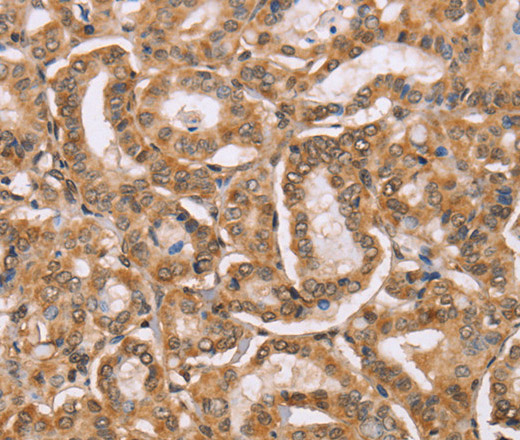 Immunohistochemistry of paraffin-embedded Human thyroid cancer tissue using BGLAP Polyclonal Antibody at dilution of 1:40