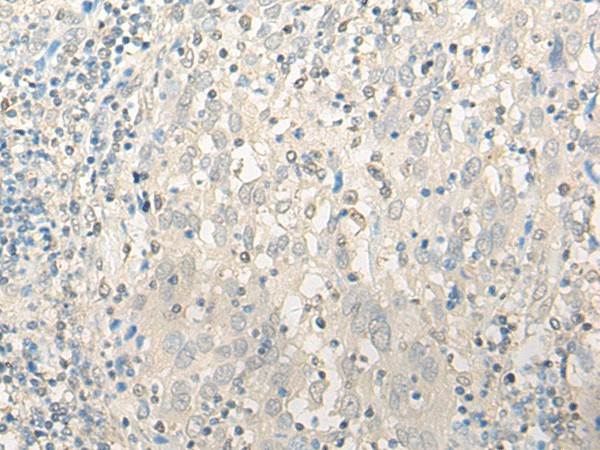 Immunohistochemistry of paraffin-embedded Human cervical cancer tissue  using UBXN1 Polyclonal Antibody at dilution of 1:35(?200)