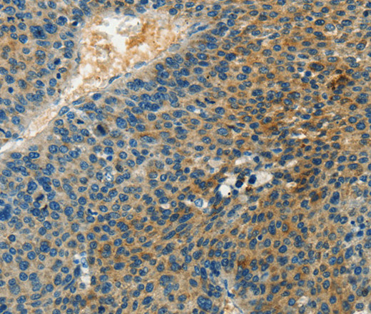 Immunohistochemistry of paraffin-embedded Human liver cancer tissue using DGK beta Polyclonal Antibody at dilution 1:60