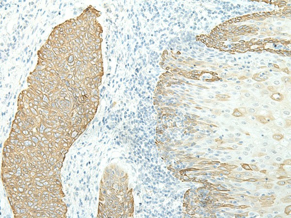 Immunohistochemistry of paraffin-embedded Human esophagus cancer tissue  using ETAA1 Polyclonal Antibody at dilution of 1:40(?200)