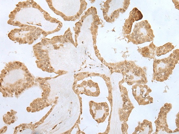 Immunohistochemistry of paraffin-embedded Human thyroid cancer tissue  using ZNF281 Polyclonal Antibody at dilution of 1:70(?200)