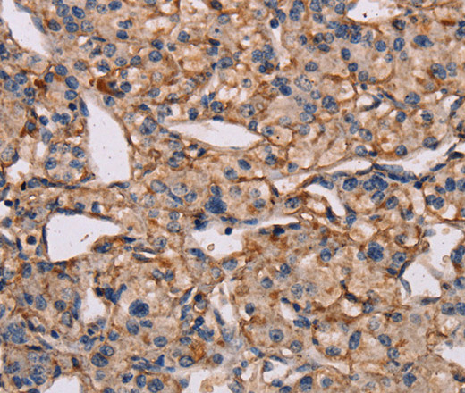 Immunohistochemistry of paraffin-embedded Human prostate cancer tissue using IL12RB2 Polyclonal Antibody at dilution 1:40