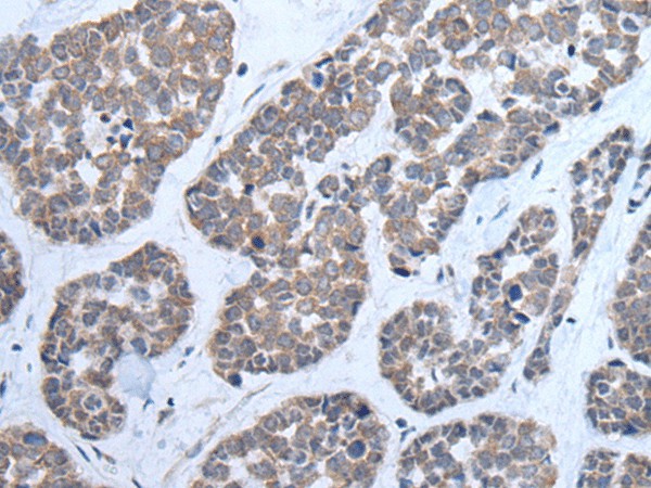 Immunohistochemistry of paraffin-embedded Human esophagus cancer tissue  using CNTN1 Polyclonal Antibody at dilution of 1:35(?200)