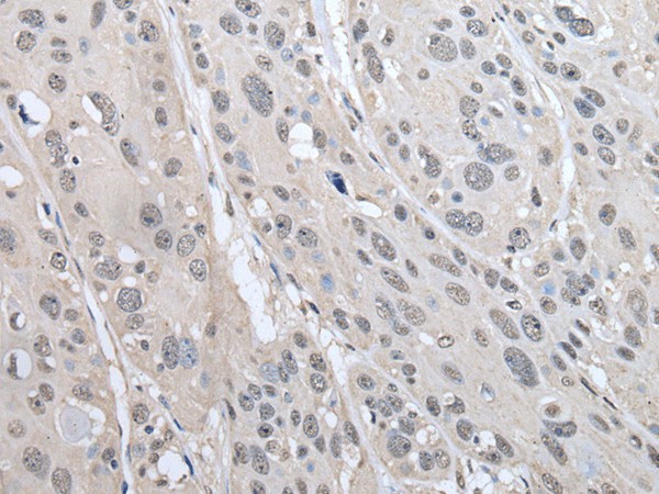 Immunohistochemistry of paraffin-embedded Human esophagus cancer tissue  using PRAME Polyclonal Antibody at dilution of 1:65(?200)