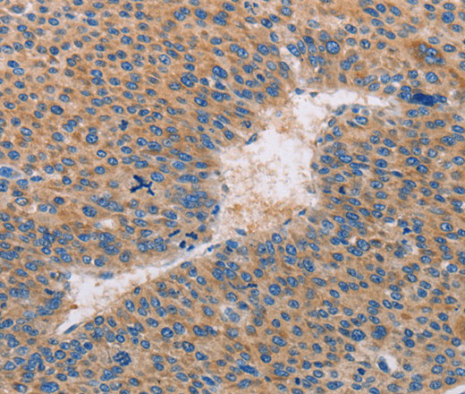 Immunohistochemistry of paraffin-embedded Human liver cancer tissue using CASP10 Polyclonal Antibody at dilution 1:30