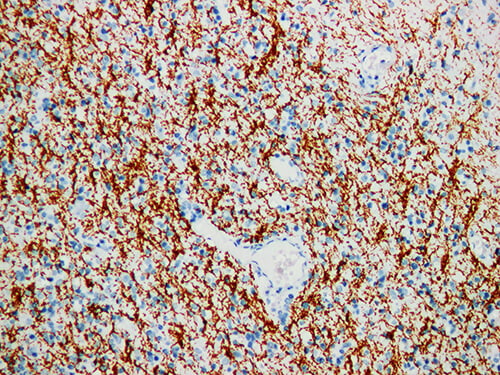 Immunohistochemistry of paraffinembedded Human glioma tissue with Myelin Basic Protein(MBP) Monoclonal Antibody(Antigen repaired by EDTA).