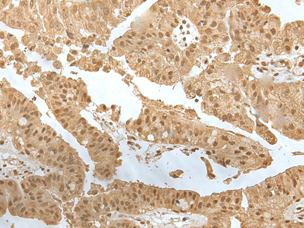 Immunohistochemistry of paraffin-embedded Human liver cancer tissue  using ZNF24 Polyclonal Antibody at dilution of 1:35(?200)