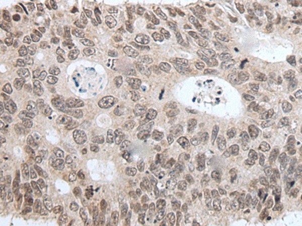 Immunohistochemistry of paraffin-embedded Human colorectal cancer tissue  using HIST1H3A Polyclonal Antibody at dilution of 1:35(?200)