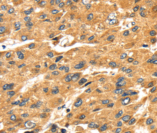 Immunohistochemistry of paraffin-embedded Human liver cancer tissue using SH3KBP1 Polyclonal Antibody at dilution 1:45