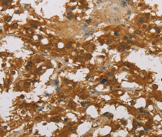 Immunohistochemistry of paraffin-embedded Human thyroid cancer tissue using CYP39A1 Polyclonal Antibody at dilution 1:50