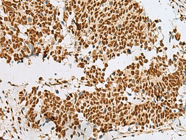 Immunohistochemistry of paraffin-embedded Human lung cancer tissue  using RBM12 Polyclonal Antibody at dilution of 1:50(?200)