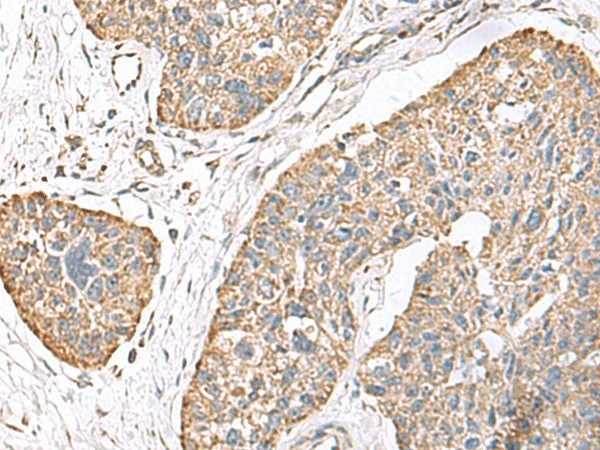 Immunohistochemistry of paraffin-embedded Human esophagus cancer tissue  using TMEM141 Polyclonal Antibody at dilution of 1:70(?200)