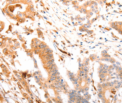 Immunohistochemistry of paraffin-embedded Human colon cancer tissue using ABCA4 Polyclonal Antibody at dilution of 1:30