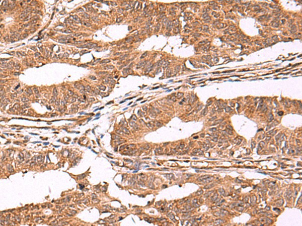 Immunohistochemistry of paraffin-embedded Human colorectal cancer tissue  using IST1 Polyclonal Antibody at dilution of 1:40(?200)