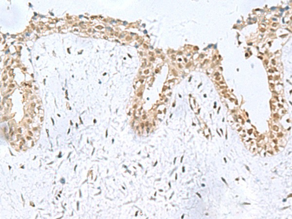 Immunohistochemistry of paraffin-embedded Human breast cancer tissue  using KDM2B Polyclonal Antibody at dilution of 1:50(?200)