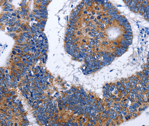 Immunohistochemistry of paraffin-embedded Human colon cancer using EEF1 gamma Polyclonal Antibody at dilution of 1:50