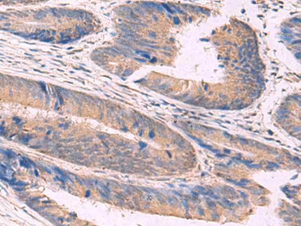 Immunohistochemistry of paraffin-embedded Human colorectal cancer tissue  using NIPSNAP1 Polyclonal Antibody at dilution of 1:50(?200)